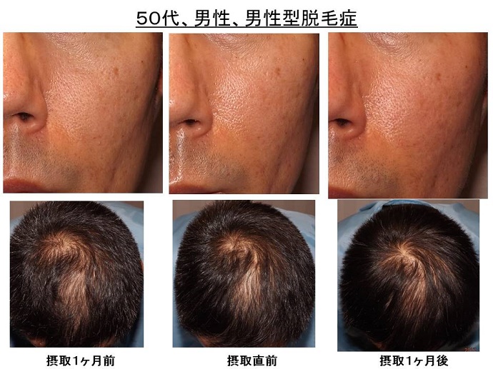 男性型脱毛症　名医""